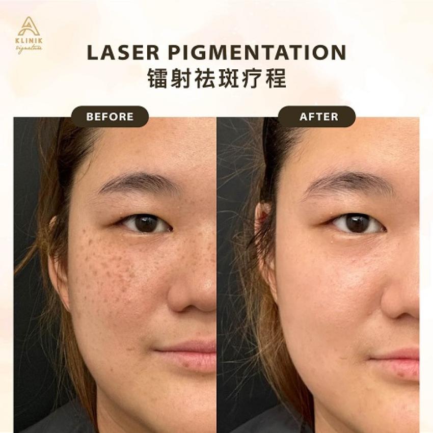 Where Can You Get Affordable Skin Booster Treatment in Malaysia? - Ani Articles