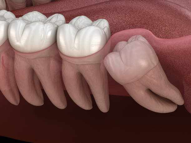 Why Ignoring Impacted Wisdom Teeth Can Be Risky