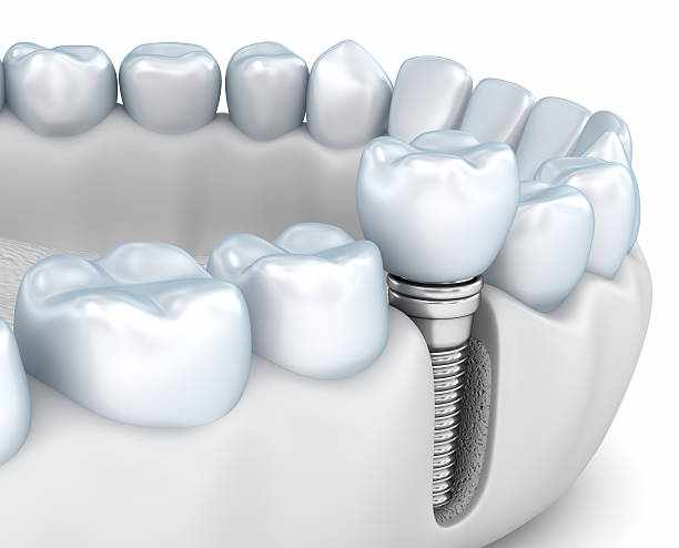 What Happens If You Delay Replacing Missing Teeth?